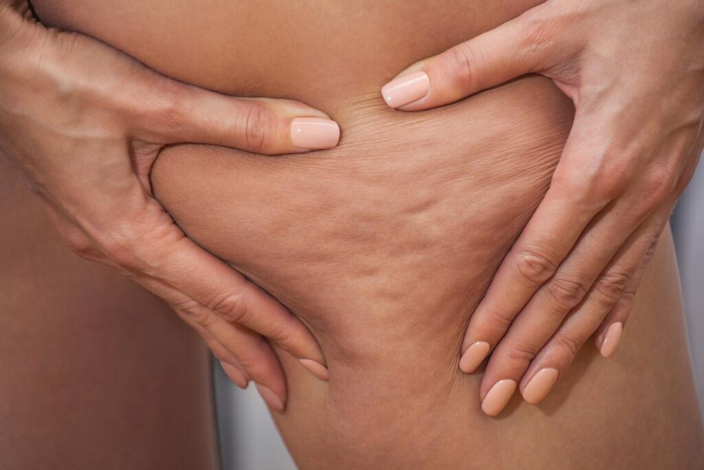 es efectiva la presoterapia para la celulitis